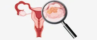 Yumurtalık kanseri tedavisi Ankara